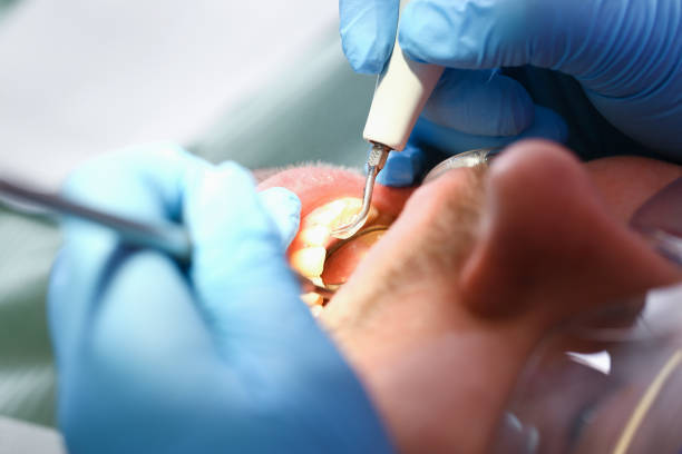 Best Emergency Tooth Extraction in Huntgburg, IN