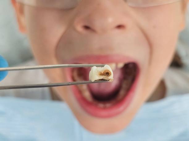 Best Emergency Wisdom Teeth Removal in Huntgburg, IN